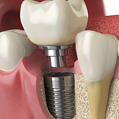 ایمپلنت در مطب خانم دکتر لیلا بازیار