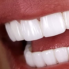 مزایای لمینت دندان