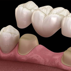 روکش دندان چیست؟