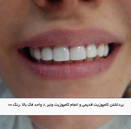 برداشتن کامپوزیت قدیمی و انجام کامپوزیت ونیر ۸ واحد فک بالا .رنگ ow