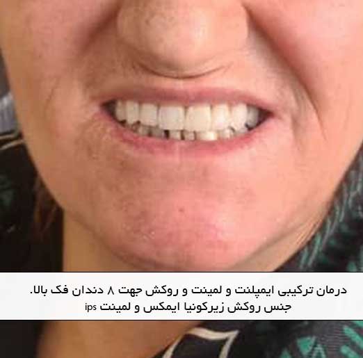 در مان ترکیبی ایمپلنت و لمینت و روکش جهت ۸ دندان فک بالا. جنس روکش زیرکونیا ایمکس و لمینت ips