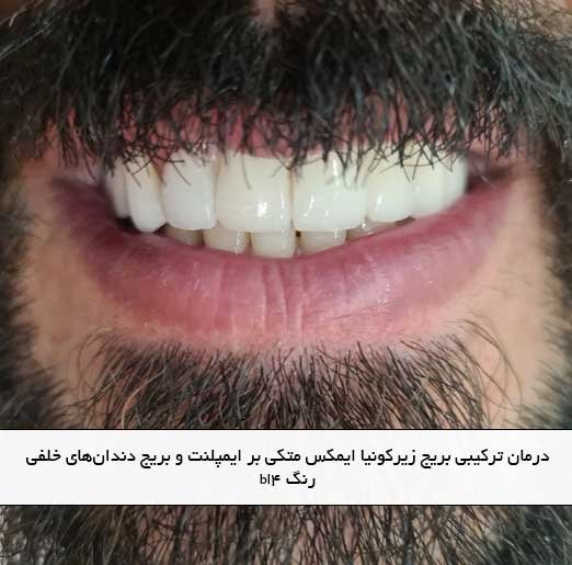 درمان ترکیبی بریج زیرکونیا ایمکس متکی بر ایمپلنت و بریج دندان‌های خلفی رنگ bl4
