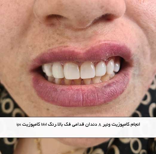 انجام کامپوزیت ونیر ۸ دندان قدامی فک بالا.رنگ blxl کامپوزیت ips