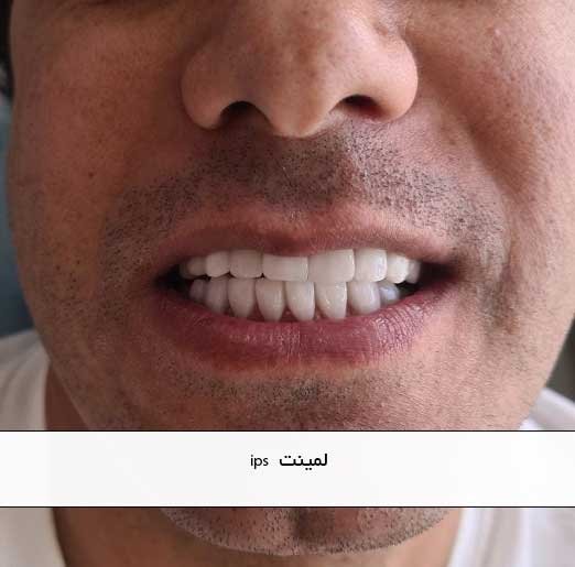 لمینت  ips