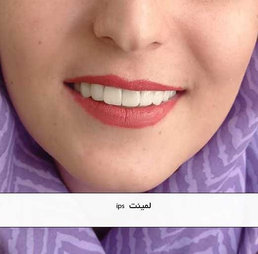 لمینت  ips